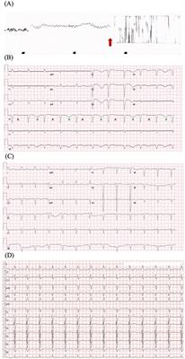 Recurrent ventricular arrhythmias and heart failure induced by osimertinib- a case report